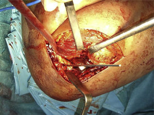 Intraoperative image. Marking of isometric point to insert an implant and repair the external ligament complex. Previously the radial head had been removed, the coronoids repaired and the radial head replaced with a monopolar prosthesis.