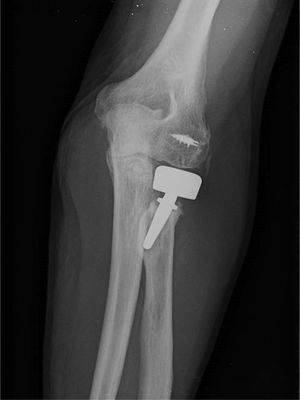 Example of Tornier® type bipolar radial head arthroplasty. Note an attachment for the reinsertion of the lateral collateral ligament complex. (LCL).
