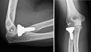 Example of Acumed® type monopolar radial head arthroplasty. Note an attachment for the reinsertion of the external lateral collateral ligament complex (LCL).