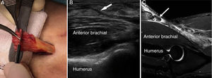 (A) Intraoperative imaging. (B) Ultrasound imaging of rupture of the distal tendon of biceps (arrow) in longitudinal slice (C) Resonance imaging of the same patient with complete rupture of the distal tendon of the biceps in sagittal sectioning.