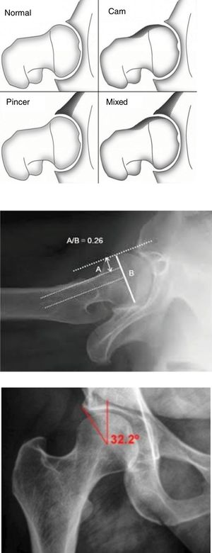 (A) Types of femoroacetabular shock. (B) Cam-type injury, assessment of α angle on axial projection. (C) Evaluation of Wiberg angle to diagnose a pincer-type lesion.