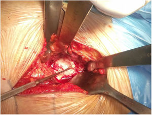 Identification of gibbus in open femoroplasty.