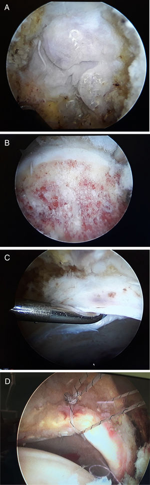 (A) Image of cam-type deformity through AHS. (B) Image after performing femoroplasty by AHS. (C) Detection of labral lesion through AHS. (D) Labral suture using anchors.
