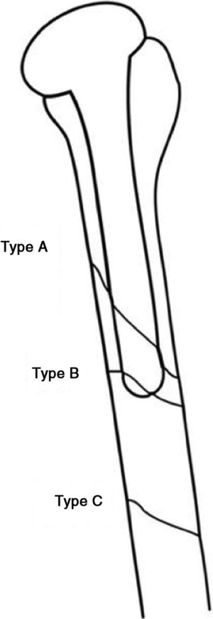Diagram of the types of periprosthetic fractures according to Wright and Cofield.6