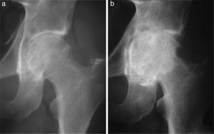 (a) Male aged 32 years with a 5 year history of pain and functional limitation in the left hip. Open surgical synovectomy was performed. (b) A year later he presented with recurrence of the lesion and advanced osteoarthritis for which finally, at the age of 33, he required a total hip arthroplasty.