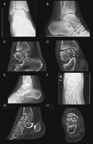 (A and B) X-rays on admission for polytrauma. No fractures were found. (C and D) CT scan requested in outpatient clinics. Complete of the astragalus body associated with osteochondral fractures and free bone fragments; no bone bridges seen. (E and F) Postoperative control X-rays. (G and H) Control CT scan at 2 months. Evidence of bone bridges.