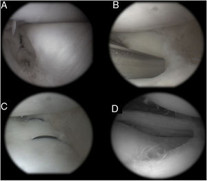 Arthroscopic images of the treatment: A) Initial presentation; B) After remodelling, performing peripheral fixation with inside-outside stitches; C) After fixation; D) Final appearance.