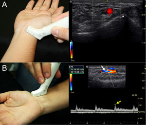 (A) Procedure for measuring the diameter of the radial artery of the right wrist. Measured at the level of the proximal palmar fold. The probe is placed transversely to locate the artery (arrow) and the measurement is taken using the styloid of the radius as a reference (asterisk). (B) Procedure to measure the flow velocity of the radial artery of the right wrist. Measured at the level of the proximal palmar fold. The probe is placed longitudinally to locate the artery (white arrow) and the peak systolic value is taken if the pulse was regular (yellow arrow).