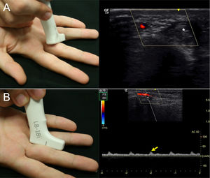 (A) Procedure for measuring the diameter of the ulnar digital artery of the third finger of the right hand. Measured proximal to the IFP joint. The probe is placed transversely to locate the artery adjacent to the flexor tendons (asterisk). (B) Procedure for measuring the flow velocity of the ulnar digital artery of the third finger of the right hand. Measured proximal to the IFP joint. The probe is placed longitudinally to locate the artery and the systolic peak value is taken if the pulse was regular (yellow arrow).