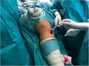 Surgical incision for obtaining autologous hamstring tendons.