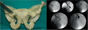 First osteotomy; pubic osteotomy immediately after the teardrop. Supervised by antero-posterior pelvic X-rays.