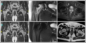 Previous MRI images showing bone marrow oedema at the level of the femoral head and intertrochanteric area. Control MRI images showing complete disappearance of the area of oedema in all cases.