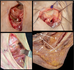 A. Anterior tibiotalar ligament (1) and interosseous talocalcaneal ligament (2). Insertion of EDB (3). B. Field of view of the neck with sectioning of ATFL (1) and without removal of EDB (3). C. Field of view of head with opening of EDB (3) without removal of anterior inferior tibiofibular ligament (4). D. Structures at risk. Medial dorsal cutaneous branch of the superficial fibular nerve (5), intermediate dorsal cutaneous branch of the superficial fibular nerve (6) and dorsolateral cutaneous branch of the sural nerve (7).
