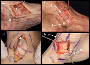 A. Superficial deltoid ligament (1). B. Opening of the deep deltoid ligament. Anterior tibiotalar fascicle (2) and tibionavicular fascicle (3). C. Structures at risk. Internal saphenous nerve and great saphenous vein (4). D. Field of view after opening of deep deltoid fascicles. Anterior tibial route (5) and posterior tibial route (6).