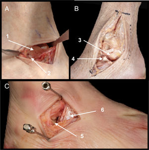 A. Field of view of the lateral process and posterior subtalar joint (1). Extensor retinaculum (2). B. Pure lateral route where the ATFL is exposed with superior and inferior fascicle (3) and the talus and posterior subtalar lateral process (4). C. Presentation with anatomical variant in which the inferior fascicle of the ATFL is jointed with fibres of the PCL above the lateral process of the talus (5). Sectioning of the interosseous talocalcaneal ligament. (6).