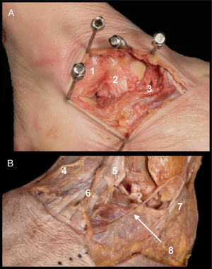 A. Extended anterolateral route. After sectioning of the ATFL (1) and lateral talocalcaneal ligament (2) proximal removal of the EDB (3) is performed to view the neck of the talus. B. Structures at risk. Medial dorsal cutaneous branch of the superficial fibular nerve (4), extensor digitalis longus (5), intermediate dorsal cutaneous branch of the superficial fibular nerve (6), peroneal tendons (7) and branches of the sural nerve (8).