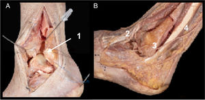 A. Field of view following osteotomy of the fibula. Sectioning and identification of borders of anterior syndesmosis and ATFL (1). B. Intermediate dorsal branch of the superficial fibular nerve (2), sural nerve branches (3) and peroneal tendons (4).