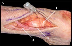 PL. Field of view of the posterior process of the talus. Approach between peroneal tendons and FLH and achilles tendon. For viewing the posterior subtalar ligament opening of the posterior tibiotalar ligament and of the posterior intermalleolar ligament is required (1). The main risks are: sural nerve (2) and lesser saphenous vein (3).