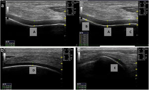 Ultrasound measurements of articular cartilage.a: Measurement of femoral cartilage at points (A, B, C). b: Measurement of femoral cartilage at point D. c: Measurement of femoral cartilage at point E.