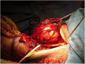 Surgical image showing an anterior approach to the elbow to perform a tumour resection with preservation of the limb (case 4).
