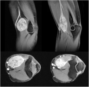 MRI images showing an epithelioid sarcoma in the anterior aspect of the elbow in which the close relationship of the tumour with the neurovascular structures can be seen (case 10).
