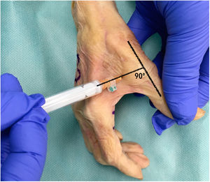 Dorsal ulnar injection performed in each thumb at the metacarpophalangeal joint keeping the thumb in maximum abduction, directing the needle towards the subcutaneous cellular tissue at the level of the first metacarpal head at a 90° angle to the thumb axis.