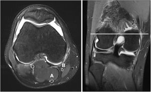 Preoperative magnetic resonance study showing the semintendinosus (A) and gracilis (B) tendon.