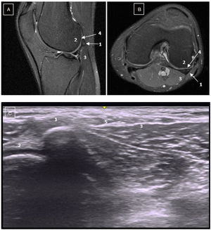 A) NMR: sagittal slice. B) NMR: transversal slice. C) Ultrasound scan. 1: Fabella. 2: Posterolateral femoral condyle, note the chondral irregularity of the lateral femoral condyle in comparison with the medial. 3: Proximal belly of the lateral gastrocnemius. 4: Femoral condyle chondral flattening. 5: Common peroneal nerve.