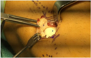 Fabellectomy, surgical approach. 1) Fabella (note the central chondral defect). 2) Posterolateral femoral condyle with chondral irregularity. 3) Common peroneal nerve separated medially.