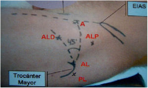 Arthroscopic portals. EIAS: anterosuperior iliac spine. A, anterior; AL, anterolateral; ALD, anterolateral distal; PL, posterolateral.