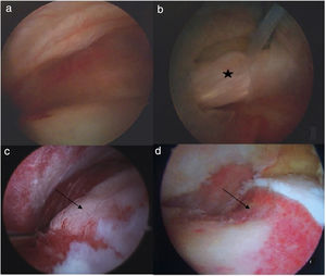 Arthroscopic hip surgery AHS. A) Central compartment. B) Central compartment showing labral rupture (star). c) Peripheral compartment with CAM-type deformity (black arrow). D) Peripheral compartment after CAM-type deformity resection osteoplasty (black arrow).