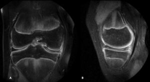 Coronal (A) and sagittal (B) imaging of magnetic resonance of the right knee which show a complete medial discoid meniscus occupying the entire medial compartment. There is meniscal intrasubstance deterioration but no rupture.