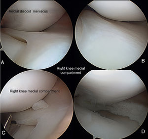 Images of right knee arthroscopy before (A and B) and after (C and D) remodelling of the complete medial discoid meniscus.
