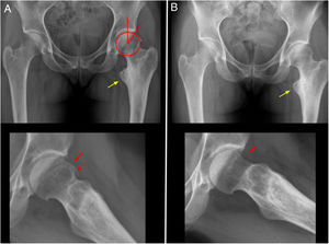 32-year-old female patient. A) Pre-operative antero-posterior X-ray and profile; LCEA=25°; Tönnis angle=10°; alpha angle=80°. Yellow arrow: coxa valga and extra rotation; continuous red arrow: cam- type deformity; dotted red arrow: ring osteophyte (For interpretation of the references to colour in this figure legend, the reader is referred to the web version of this article).