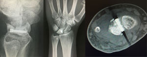 Plain lateral, posteroanterior x-ray and axial CT slice after six months of evolution where the correct implantation of osteosynthesis material and fracture consolidation may be observed.