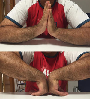 Clinical imaging six months after surgery where an extension of the injured wrist (right) of 75°and flexion of 65° is observed.
