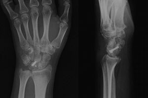 Plain posteroanterior and lateral x-ray where fracture consolidation is observed.