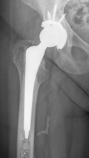 Example of cement arteriovenogram in a total hip arthroplasty. The characteristic radiographic image is shown, of linear and ascending morphology, positioned in the postero-internal side of the proximal femoral third.