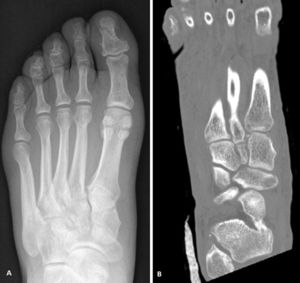 Initial X-ray (A) and CT image (B) confirming the diagnosis of suspected TMC injury. The fleck sign can be seen with the longitudinal CT cut (B).