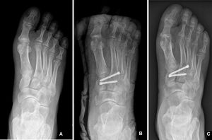 60-year-old male, with subtle TMC injury; MOXFQ score at 12 months of 5 points. A). Preoperative non-weight-bearing X-ray note fleck sign visible between M2 and C1. B) Postoperative control radiography. C) Post-surgical weight-bearing radiography at 12 weeks after the intervention.