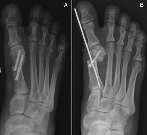 A) Percutaneous Chevron osteotomy, fixation with two screws. B) Bösch osteotomy with screw and Kirschner wire placement.