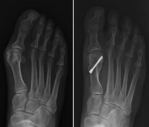 Follow-up at one year following Bösch osteotomy.