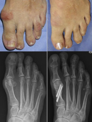 Follow-up at one year following percutaneous Chevron osteotomy.