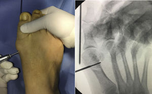 Intraoperative image of percutaneous Chevron osteotomy.