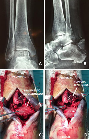 X-rays of the ankle and foot, in anterior posterior and lateral projections. An avulsion fracture of the posterior calcaneal tubercle is observed (A and B). Fracture of the posterior calcaneal tubercle and proximal complete rupture of the Achilles tendon (C and D).