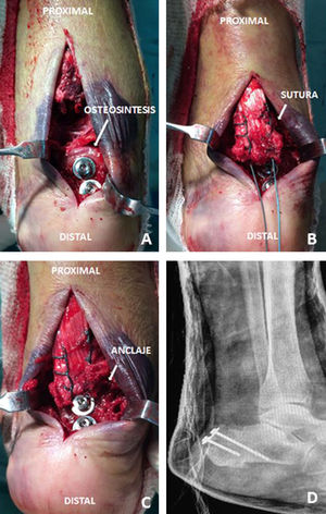The Achilles tendon injury was repaired with a Krackow type suture with Ethibond Excel 2-0 (Ethicon®, 1003 U.S. 202, Raritan, NJ 08869, USA) distally anchored to the osteosynthesis materials (A, B, C and D).