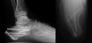 Final result of the previous case nine months after surgery.