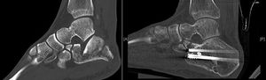 A-B) Pre and postoperative CT of Sanders type iii fracture treated with indirect reduction and cannulated screws, good recovery of articular congruence.