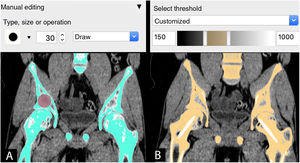 Segmentation tools at Invesalius (Centro de Tecnologia da Informação Renato Archer, Campinas, SP, Brazil). A): Paint brush-type manual. B) Automatic threshold type.