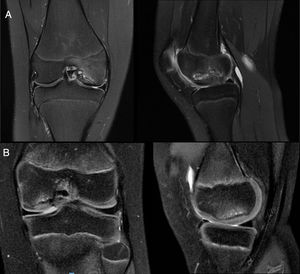 A) Magnetic resonance in coronal and saggital slices where an unstable lesion was observed in the medial femoral condyle in keeping with the criteria of Kijowski et al.21: a high T2 signal intensity rim which had the same signal intensity as the adjacent joint fluid; a secondary outer rim of low T2 signal intensity; multiple breaks in the subchondral bone plate, and the existence of multiple cysts or only one cyst above 5 mm in diameter. In addition to this, in this case, disruption of the joint cartilage was observed. B) Magnetic resonance in coronal and sagggital slices where we observed a stable lesion with osseous subchondral oedema in the medial femoral condyle but with none of the previously described features.